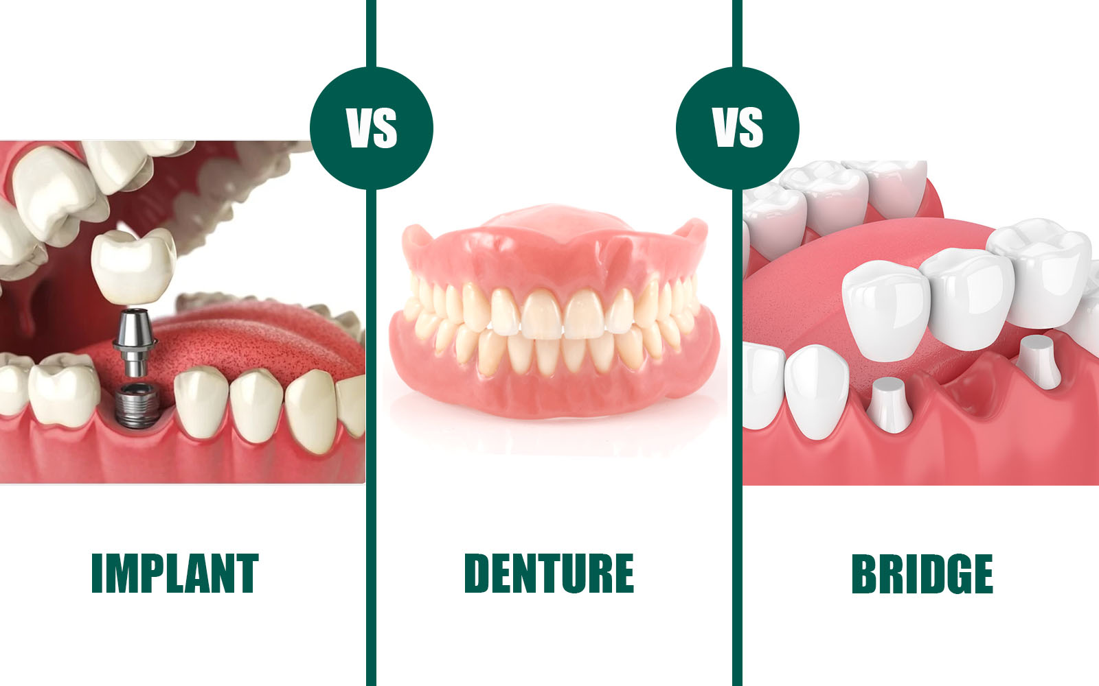 implant-vs-denture-vs-bridge.jpg